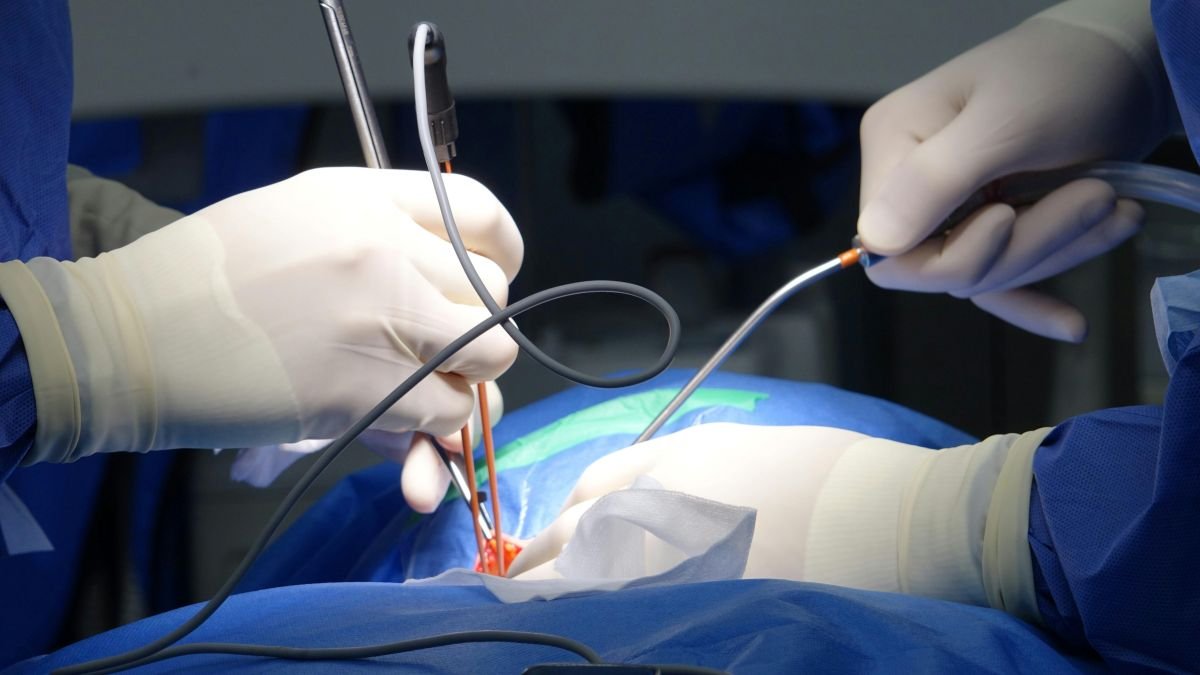 Minimally Invasive Spine Surgery for Back Pain: When Is It an Option?
